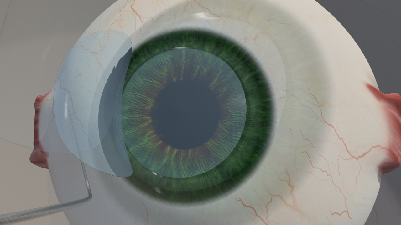Femto Lasik 